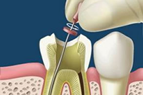 Endodoncia